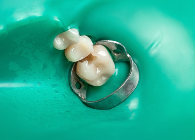 ラバーダム防湿