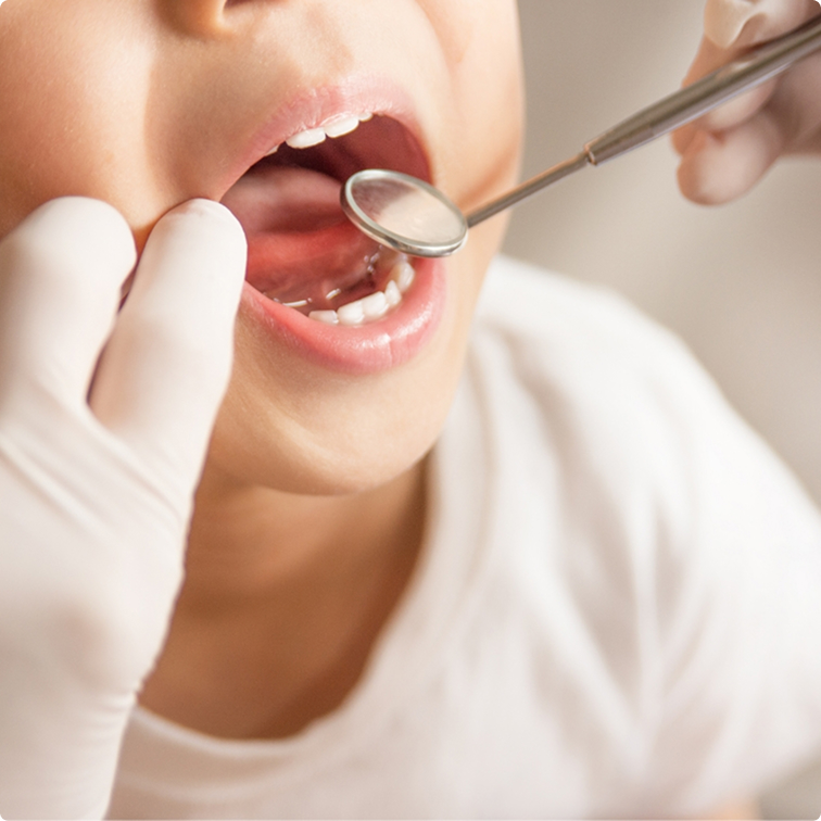 子どもの歯治療